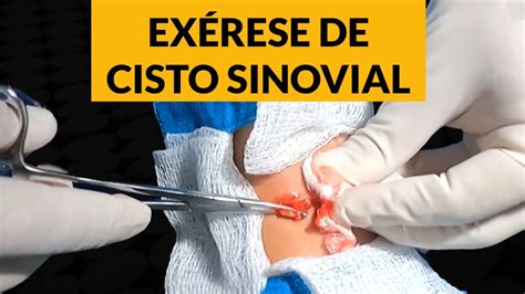 Synovial Cyst Wrist Hot Sex Picture