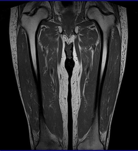 Jun 28, 2021 · the thigh is the region between the hip and knee joints. thigh mri t1 tse coronal image