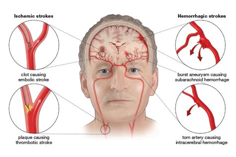 Ich is most commonly due to rupture of small perforating arteries due to unrecognized or uncontrolled hypertension. Hemorrhagic Stroke Treatment - Stroke Awareness Foundation