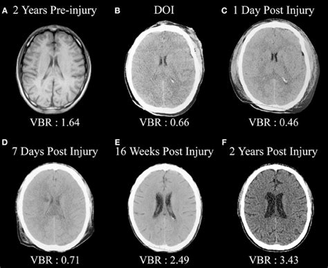 Frontiers Traumatic Brain Injury Neuroimaging And Neurodegeneration