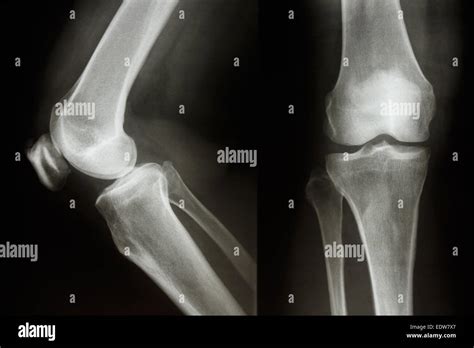 Film X Ray Show Normal Knee Jointaplateral Stock Photo Alamy
