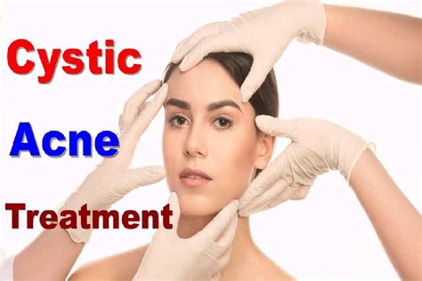 Cystic Acne Treatment Treatments Topical Retinoids