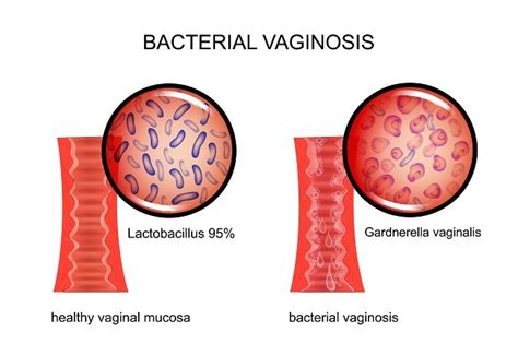 Bakterial Vaginosis Patofisiologi Diagnosis Penatalaksanaan Alomedika
