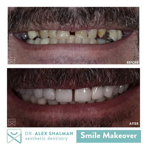 Before After Gallery Shalman Dentistry In Lower Manhattan Ny