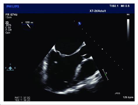 Toe Image Of The Mitral Valve With Typical Appearances Of Thickened