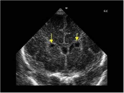 Cyst Lateral Ventricle Ultrasound