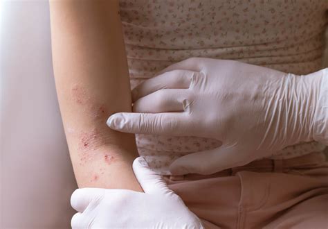 Most Common Skin Rashes Among Adults Georgia Skin Cancer And