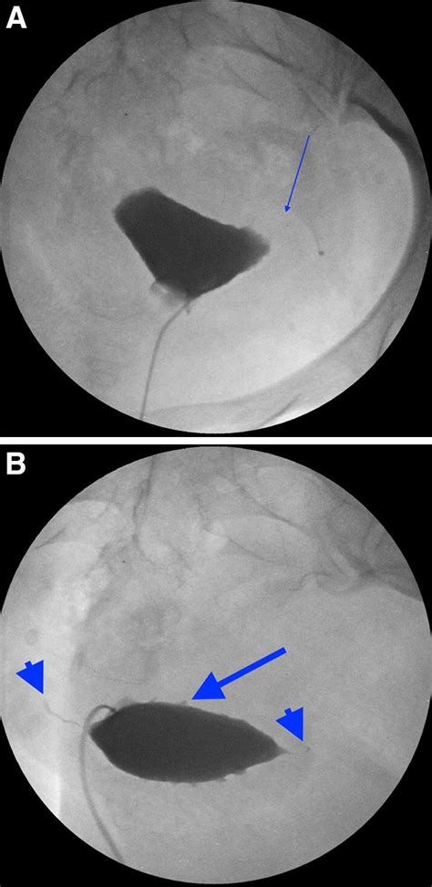 Bilateral Tubal Occlusion And Adenomyosis 34 Year Old Female With A