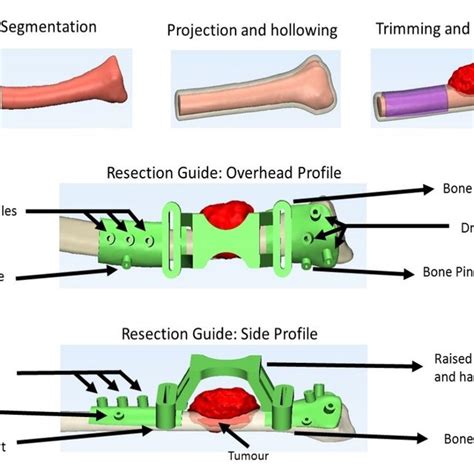 A Illustration Of Patient Specific Bone Surface Template Formation