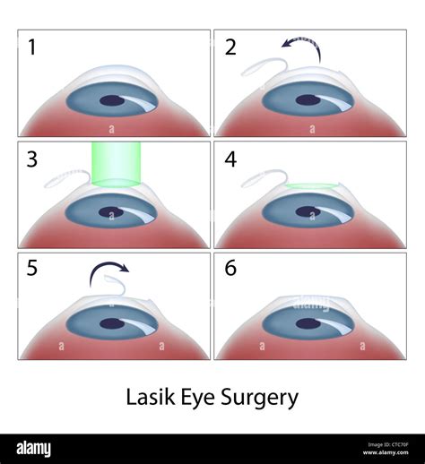 Lasik Eye Surgery Procedure Stock Photo Alamy