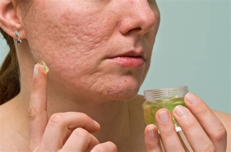Best Skin Treatment For Acne Scars Recommended By Dermatologist