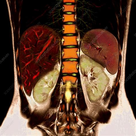 Abdominal Organs And Spine Mri Scan Stock Image C0313218