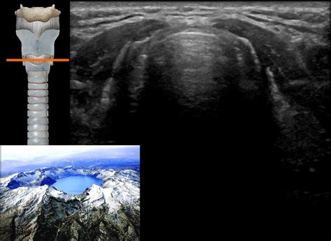 Airway Ultrasound Transverse Views • Litfl • Ultrasound Library