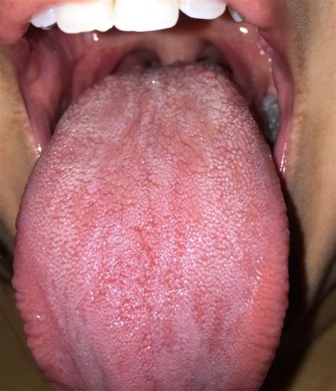 Tongue Herpes Herpes Non Genital Forums Patient