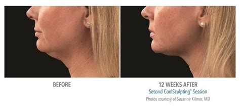 Kybella And Coolsculpting Treatment For Double Chin Fat Reduction