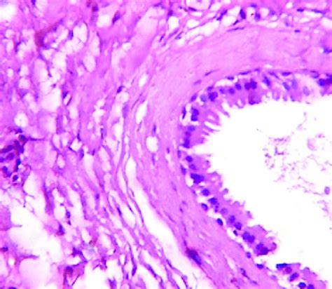 Histology Showing Cystic Lesion Lined By Apocrine Type Epithelial Cells