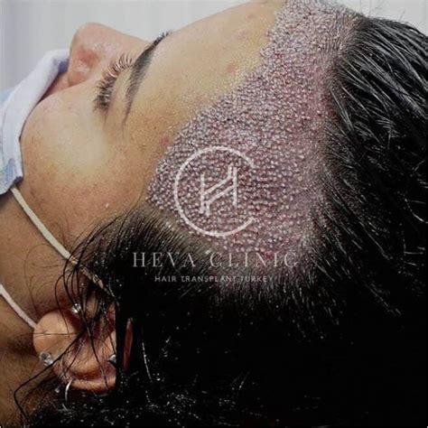 Female Hair Transplant In Turkey Costs Procedure In 2023 Heva Clinic