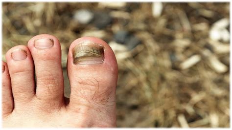 How To Cure Toenail Fungus With Tea Tree Oil A Complete Step By Step