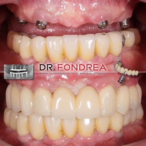 Lucrari Protetice Fixe Cu Buget Limitat Timisoara Dental Design