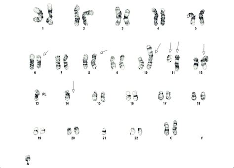 Above Chromosome Analysis Showing Abnormal Female Complex Karyotype