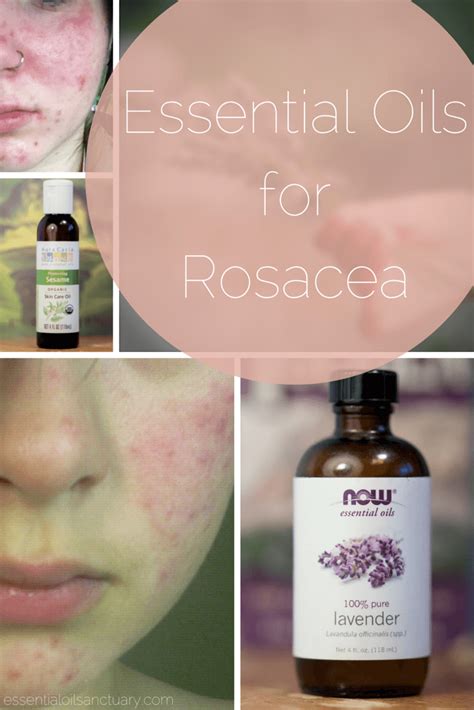 9 Essential Oil Based Recipes For Rosacea