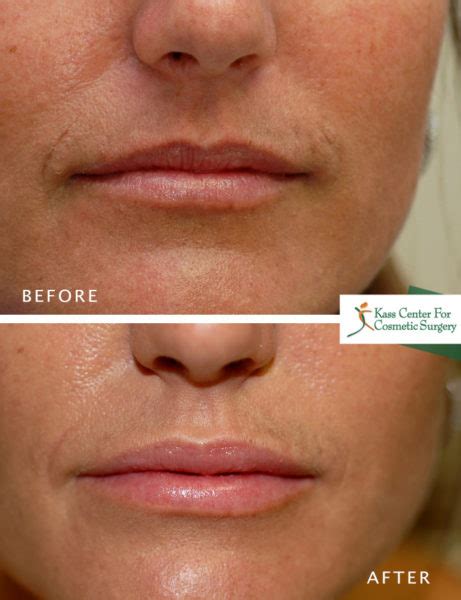 Lip Plastic Surgery Before And Afters Kass Center For Cosmetic Surgery