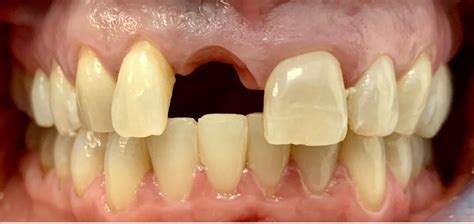 Bridges To Replace Missing Teeth Dr Gentry