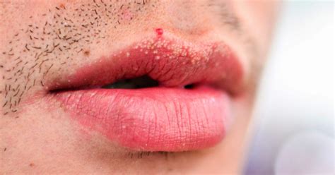 500 Abarth Hpv White Spots On Lips Heck S Disease Wikipedia Other