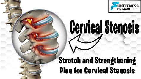 Understanding Treatment Options For Cervical Spinal Stenosis Surgery