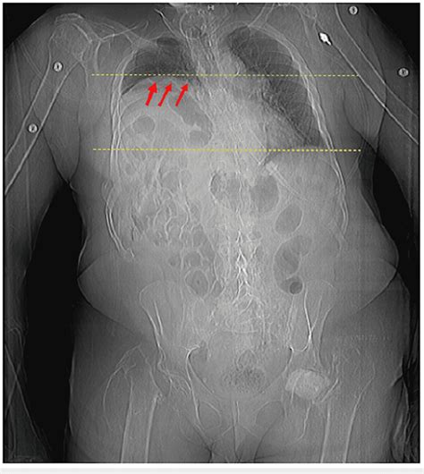 Upright Abdominal Radiograph Shows Significant Diminution Of Functional
