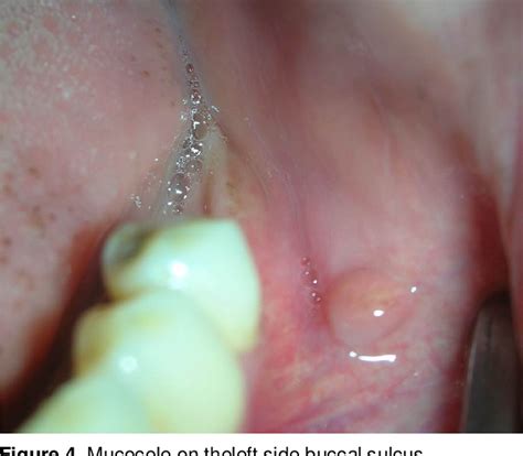 Oral Mucocele Diagnosis And Management Semantic Scholar