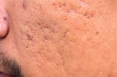 What Are The Different Acne Scars And How To Treat Them — Project Vanity