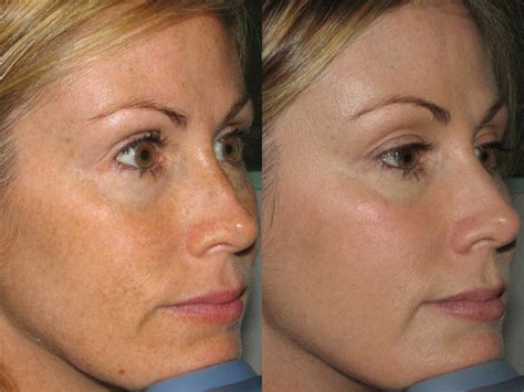 Ipl Photofacial For Skin Rejuvenation Kihei Hi Medispa Maui