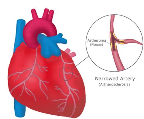 Medical Pictures Info Coronary Heart Disease