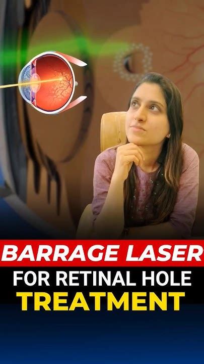 Barrage Laser For Retinal Hole Treatment Youtube