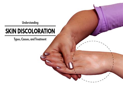 Understanding Skin Discoloration Types Causes And Treatment