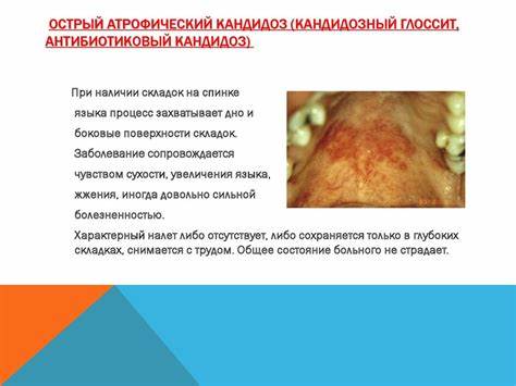 Кандидоз диета лечение