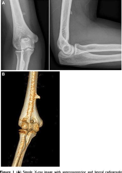 Pdf Supracondylar Process Syndrome Two Cases Of Median Nerve