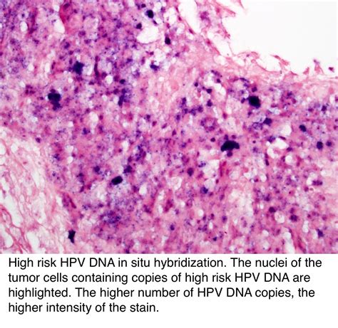 Pathology Outlines Hpv Related Oropharyngeal Squamous Cell Carcinoma