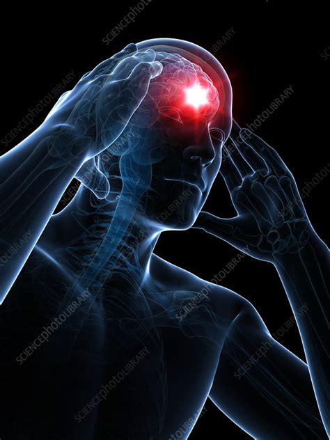 Headache Artwork Stock Image F007 7153 Science Photo Library