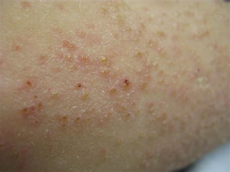 Dry Scaly Rash Mdedge Dermatology