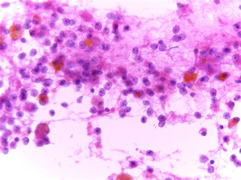 Renal Cell Carcinoma Rcc Eurocytology