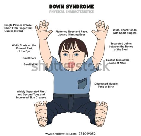 Down Syndrome Physical Characteristics Infographic Diagram Stok Vektör