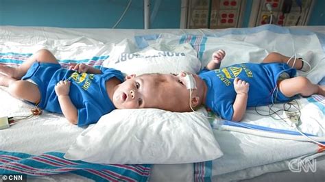 Formerly Conjoined Twin Struggles Post Surgery While Brother Thrives
