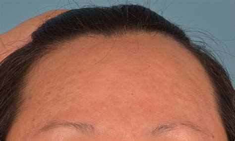 Rash On Forehead