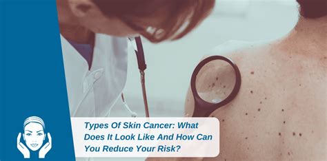 Types Of Skin Cancer And How Can You Reduce Your Risk