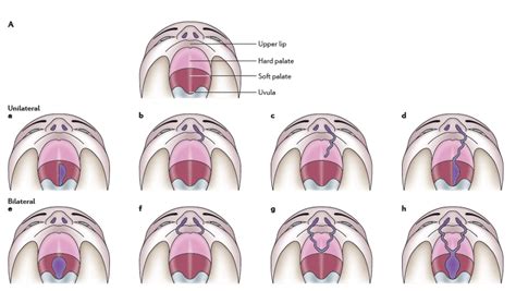 Embryology And Causes Of Cleft Cleft Lip And Palate C