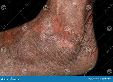 Dry And Scaly Skin And Abrasions In Foot Dermatitis Foot Stock Image