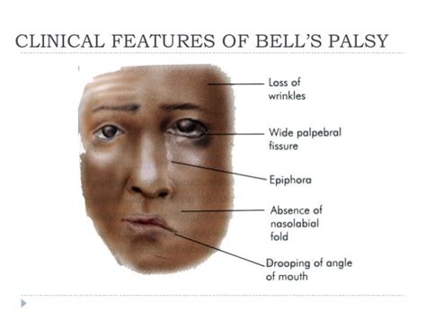 Bell S Palsy Diagram