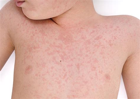 Alergia Na Pele Quais São Os Tipos Sintomas E Como Tratar Saúde